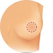 Periareolar